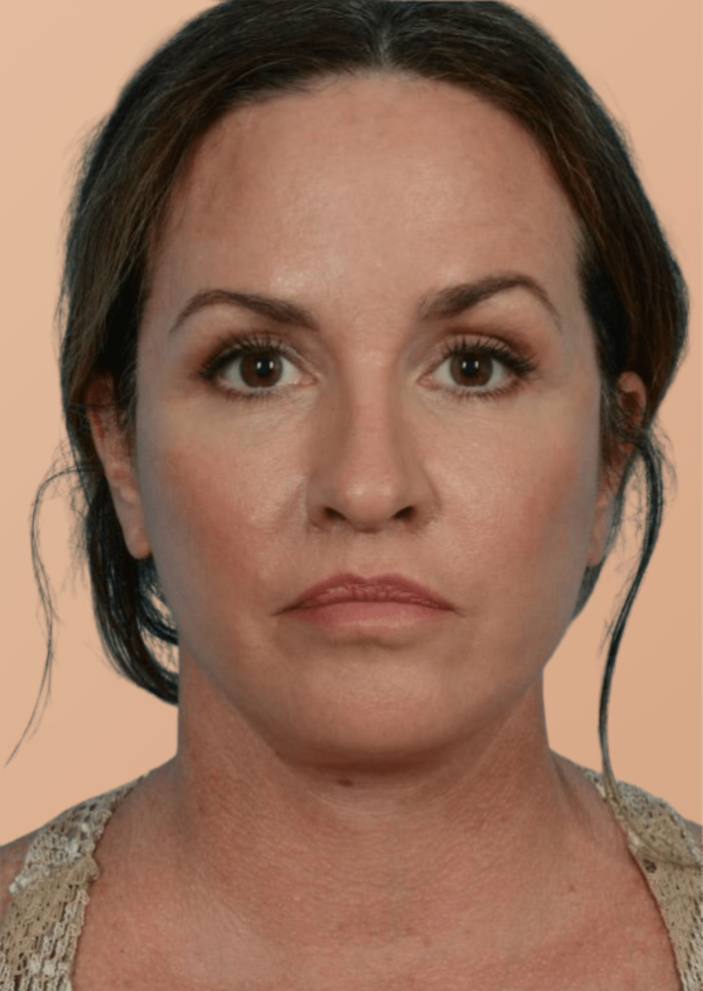 Brosse Lymphatique Sarolya